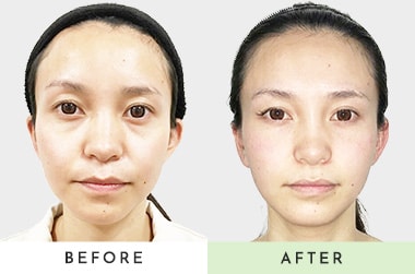 before after
