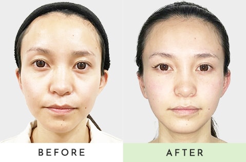 before after